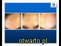 Derma roller mezoroller acne scars treatment masaż