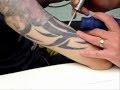 Usuwanie tatuażu laserem q switch rubinowym w centrum terapii laserowej przez dr bałazińską masaż